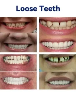 Advanced Full Denture Set