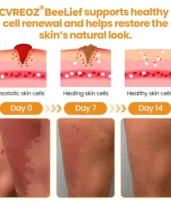 BeeLief Psoriasis Skin Care Cream