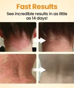 BeeLieve Psoriasis Skin Care