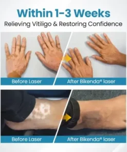 DermaBeam Vitiligo Therapy device
