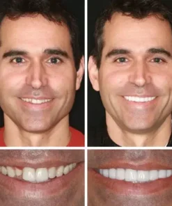 NESLEMY™ –Advanced Customized Full Denture Set