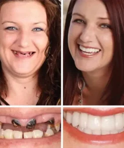 NESLEMY™ –Advanced Customized Full Denture Set