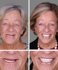 NESLEMY™ –Advanced Customized Full Denture Set