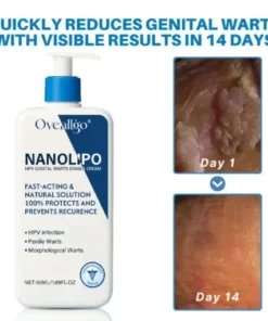 NanoLipo HPV Genital Warts Eraser Cream