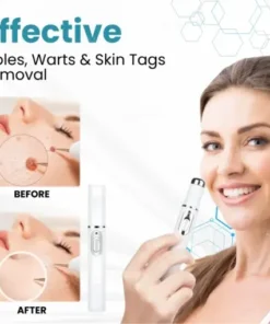Non-Invasive Mole and Wart Removal Laser Pen