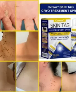 Skin Tag Cryo Treatment Spray