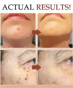Skin Tag & Mole Remover