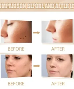 Skin Tag & Mole Remover