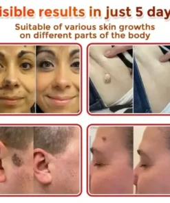 Skin Tag Removal Patch