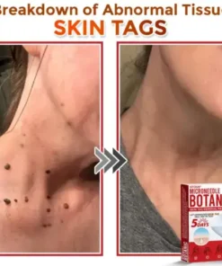 Skin Tag Removal Patch
