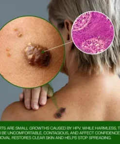 Timilk® ClinixClear Wart Remover Patch