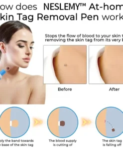 At-home Skin Tag Removal Pen