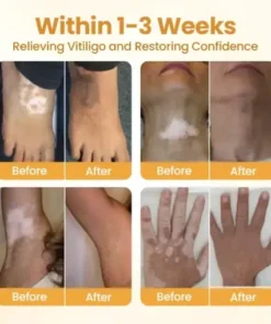 VitiClear Pro Bee Venom Cream