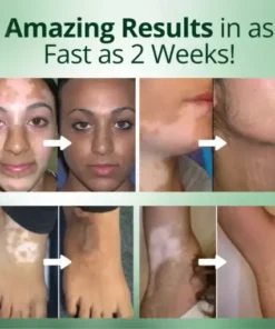 Vitiligo Treatment Cream