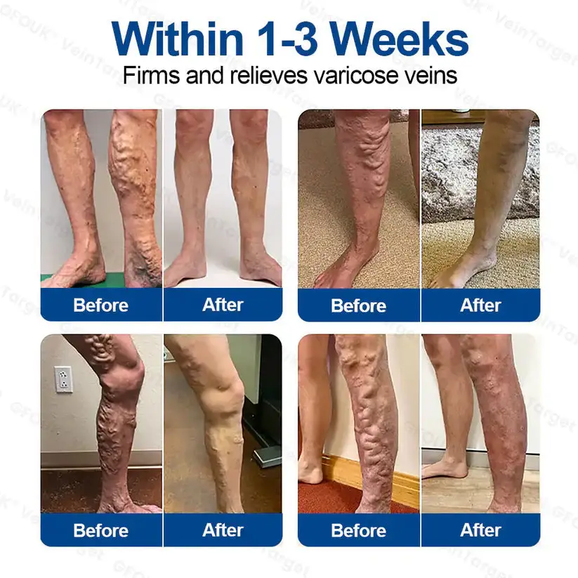 VeinTarget Microneedle PatchInstant Relief, Long-Term Results - Image 3