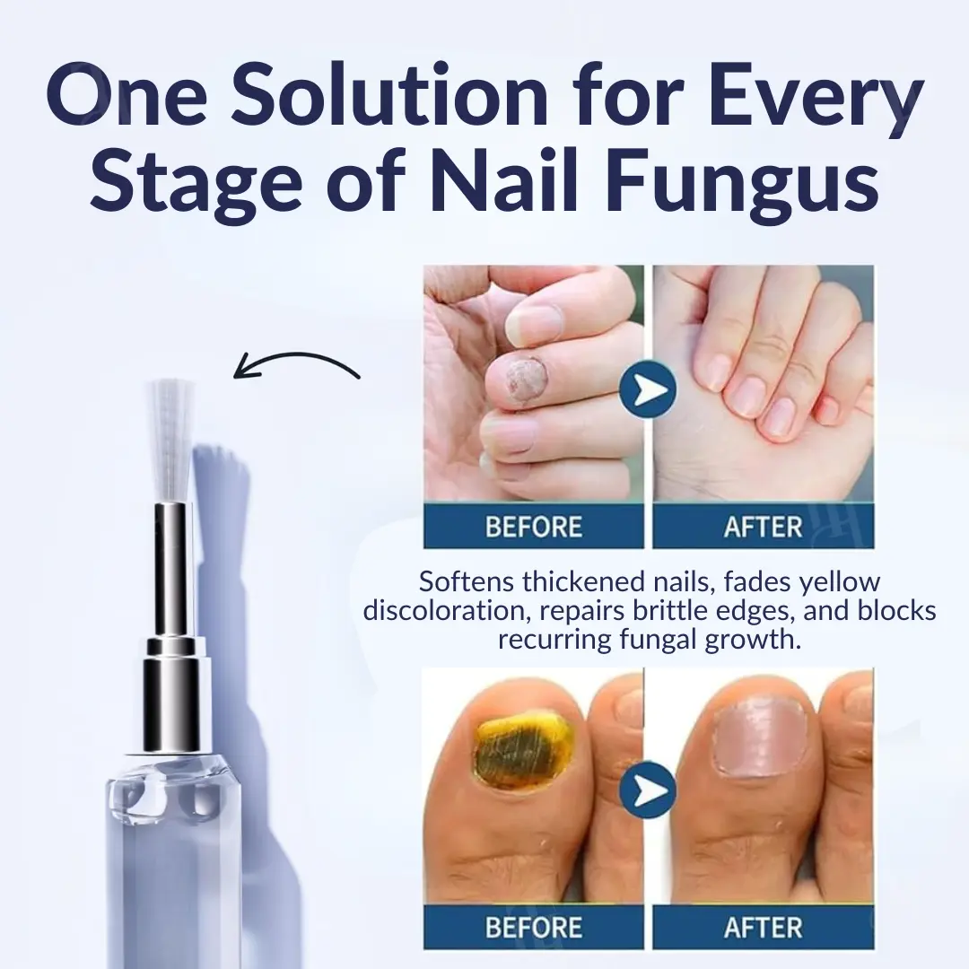 Next-Gen Antifungal Max-Pen - Image 2