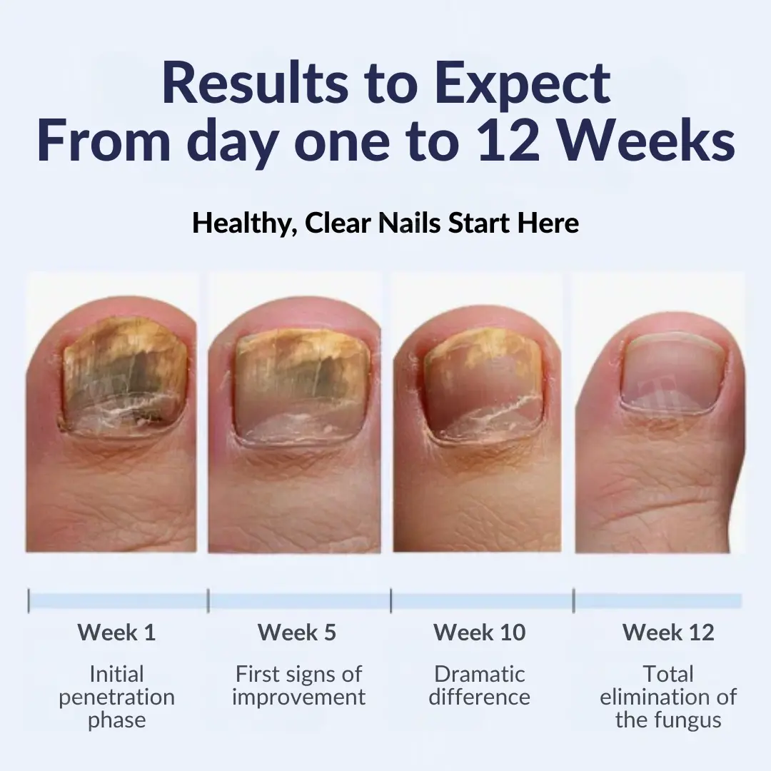 Next-Gen Antifungal Max-Pen - Image 6