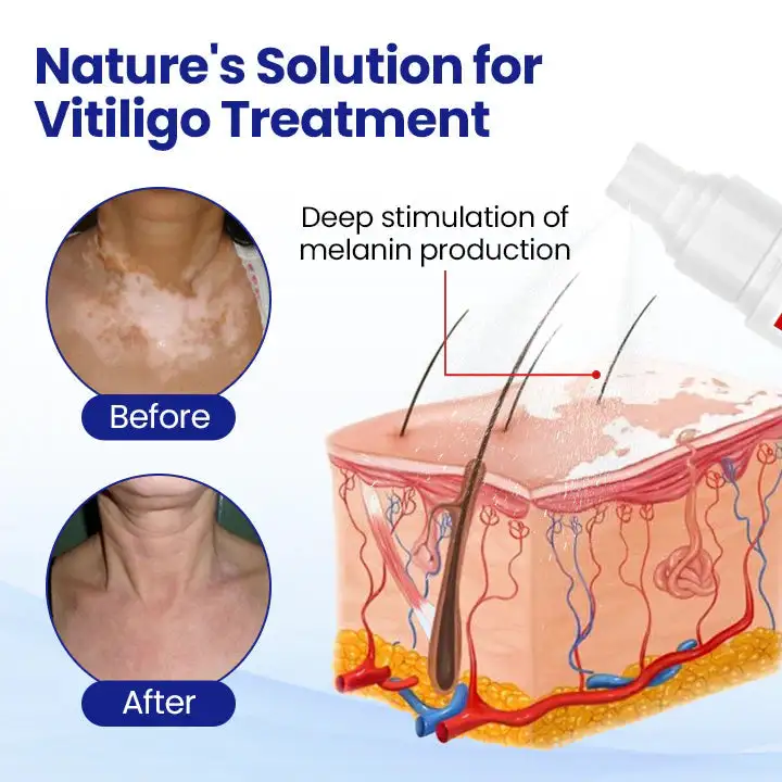 Vitiligo Treatment Spray - Image 3