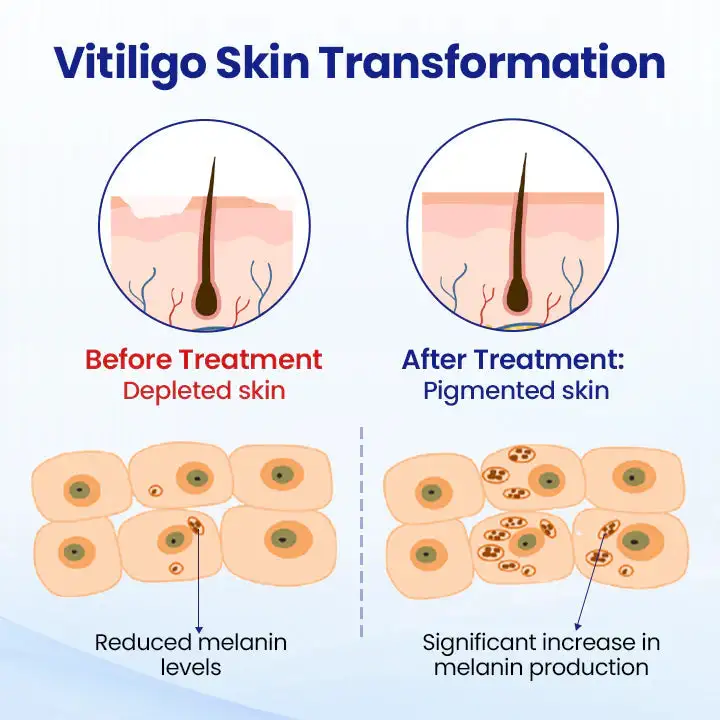 Vitiligo Treatment Spray - Image 4