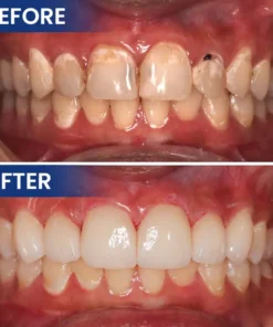 LIMETOW® Bee Venom Oral Care Solution