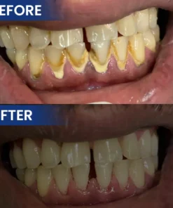 LIMETOW® Bee Venom Oral Care Solution