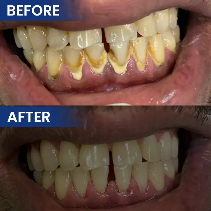 LIMETOW® Bee Venom Oral Care Solution