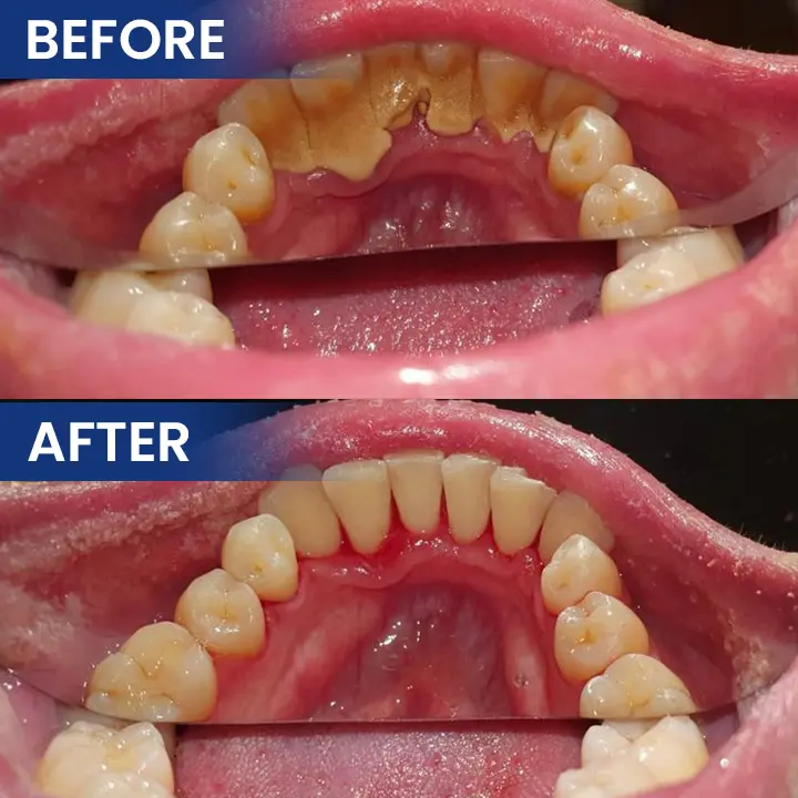 LIMETOW® Bee Venom Oral Care Solution