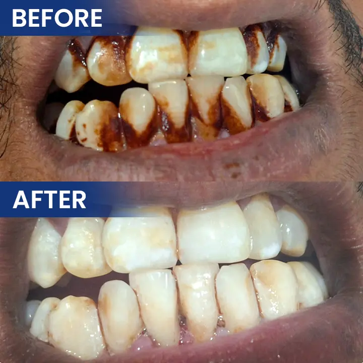 LIMETOW® Bee Venom Oral Care Solution