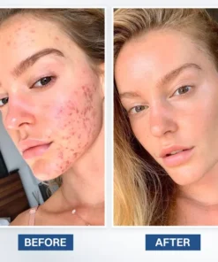 LIMETOW® Scar Removal Cream