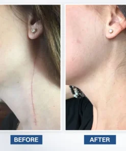 LIMETOW® Scar Removal Cream