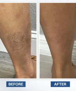 LIMETOW® Scar Removal Cream