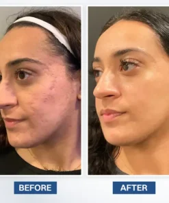 LIMETOW® Scar Removal Cream