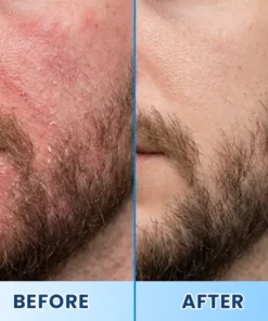 LIMETOW® Visible Beard & Scalp Relief in 7 Days Without Steroids