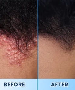 LIMETOW® Visible Beard & Scalp Relief in 7 Days Without Steroids
