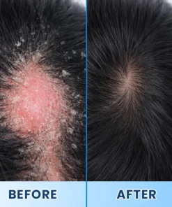 LIMETOW® Visible Beard & Scalp Relief in 7 Days Without Steroids
