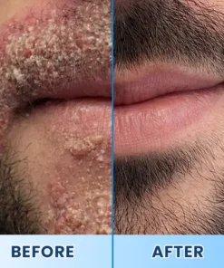 LIMETOW® Visible Beard & Scalp Relief in 7 Days Without Steroids