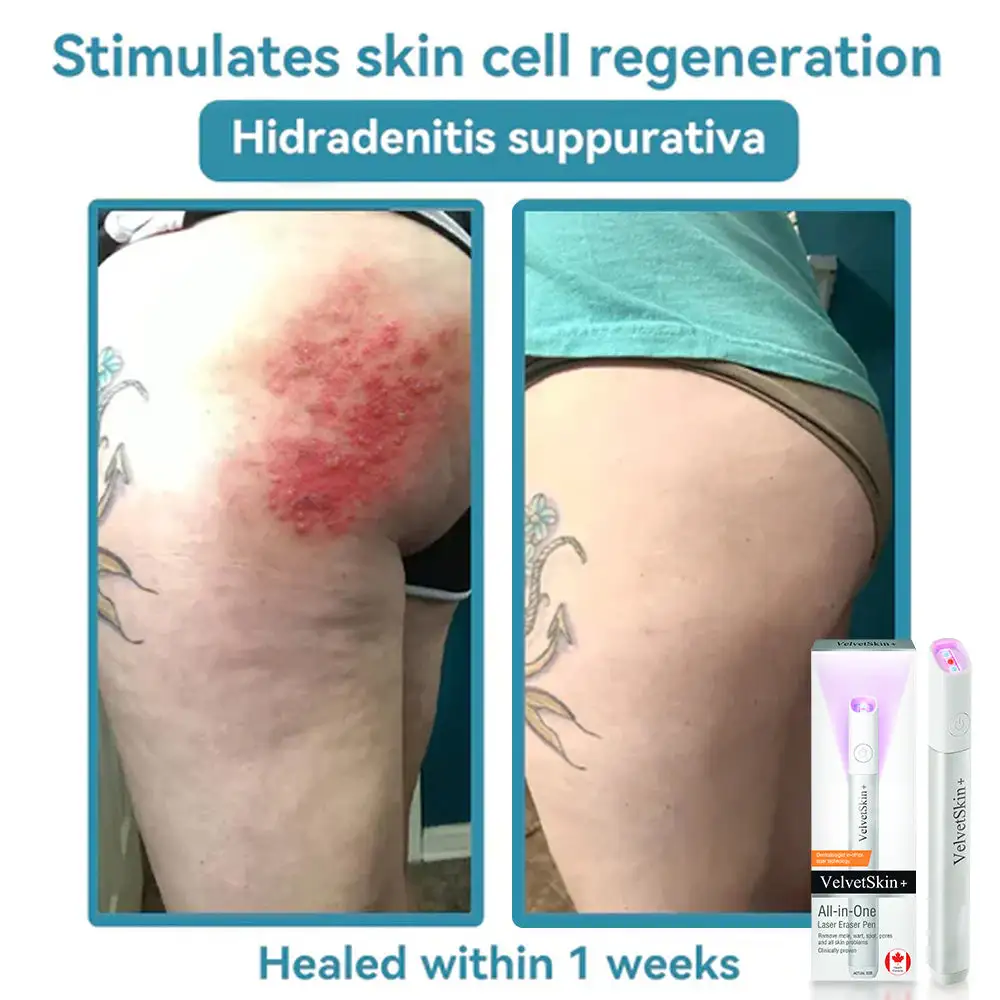 All-in-One CO₂ Laser Eraser Pen Removes Moles, Warts, Skin Flaws Pigmentation - Image 9