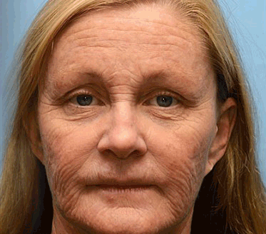 Botulinum & Vita-A Retinol Shot Wrinkle-Lift Tightening cream - Image 5