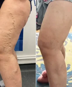 LIMETOW® Leg Relief Cream