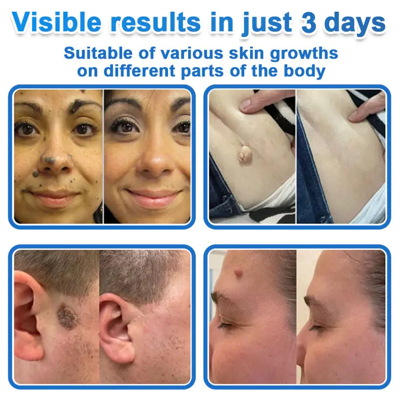 2026 Newly Upgraded 2-in-1 Microneedle Hydrocolloid Patches - Image 3