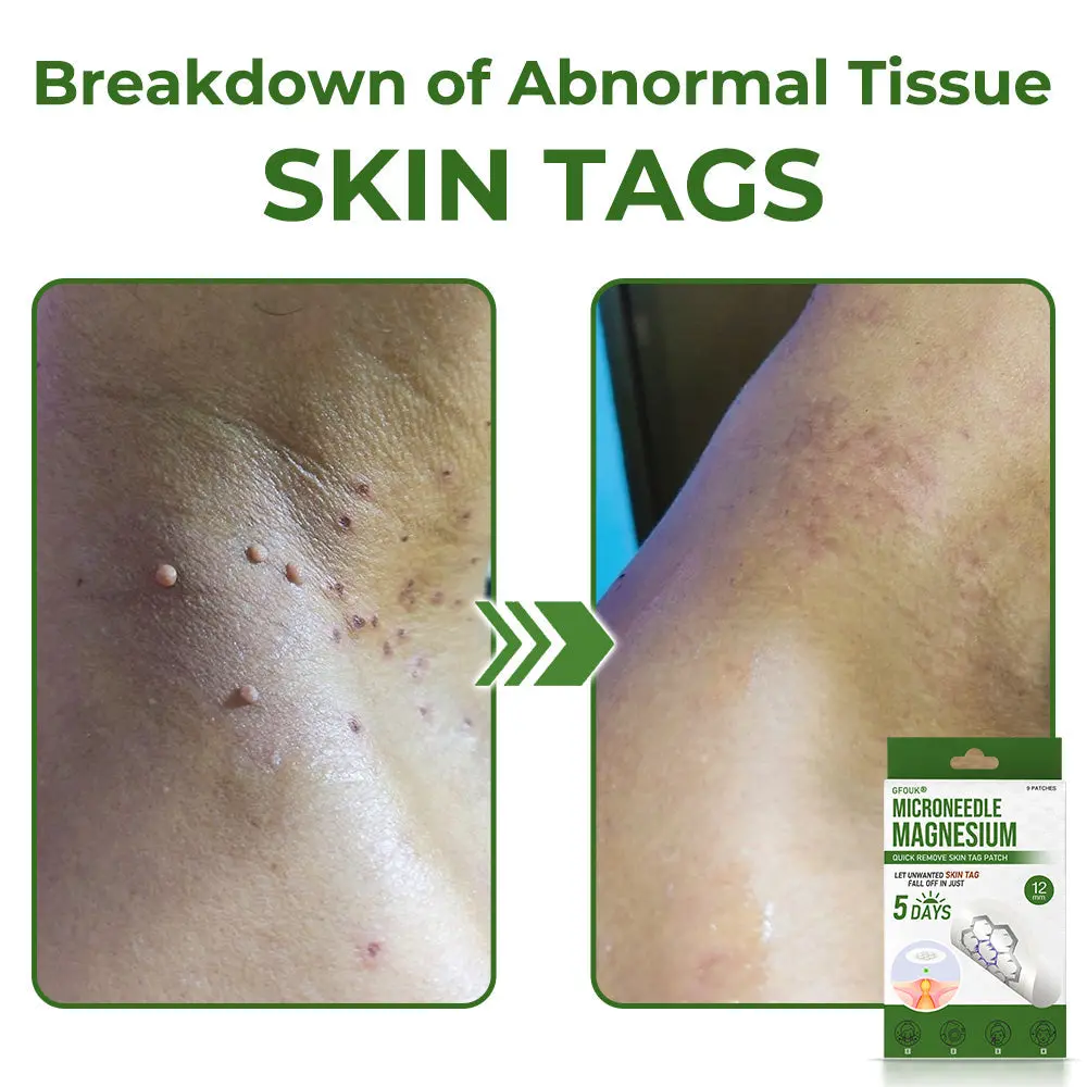 Magnesium MicroNeedle Quick Remove Skin Tag Patches - Image 3