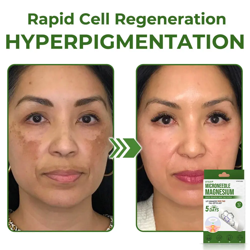 Magnesium MicroNeedle Quick Remove Skin Tag Patches - Image 5