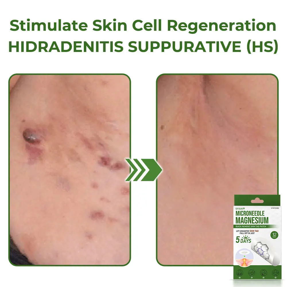 Magnesium MicroNeedle Quick Remove Skin Tag Patches - Image 7