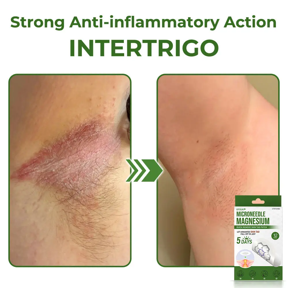 Magnesium MicroNeedle Quick Remove Skin Tag Patches - Image 8