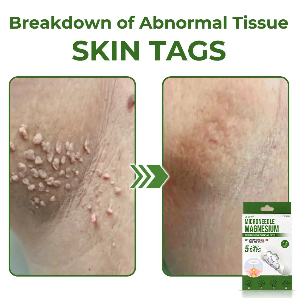 Magnesium MicroNeedle Quick Remove Skin Tag Patches - Image 9