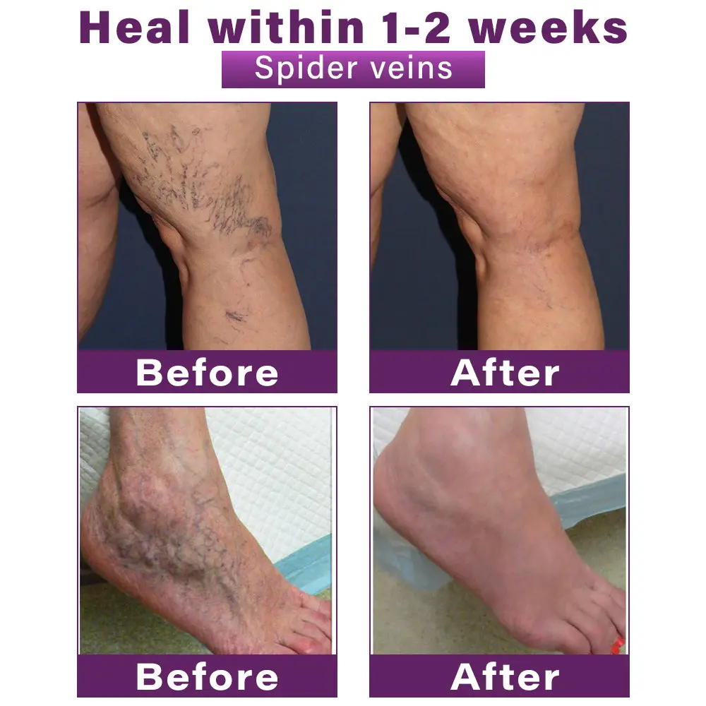 Polidocanol Nano Varicose Vein Patch - Image 2