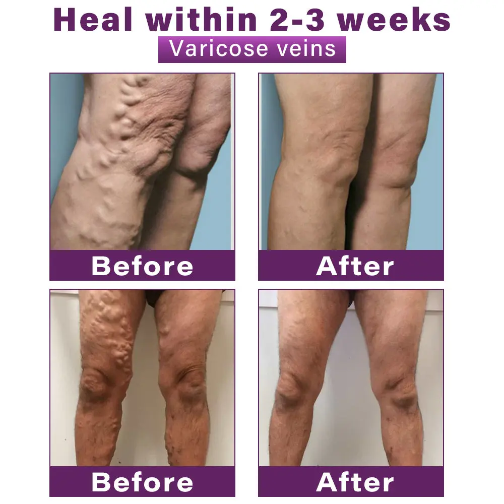 Polidocanol Nano Varicose Vein Patch - Image 3