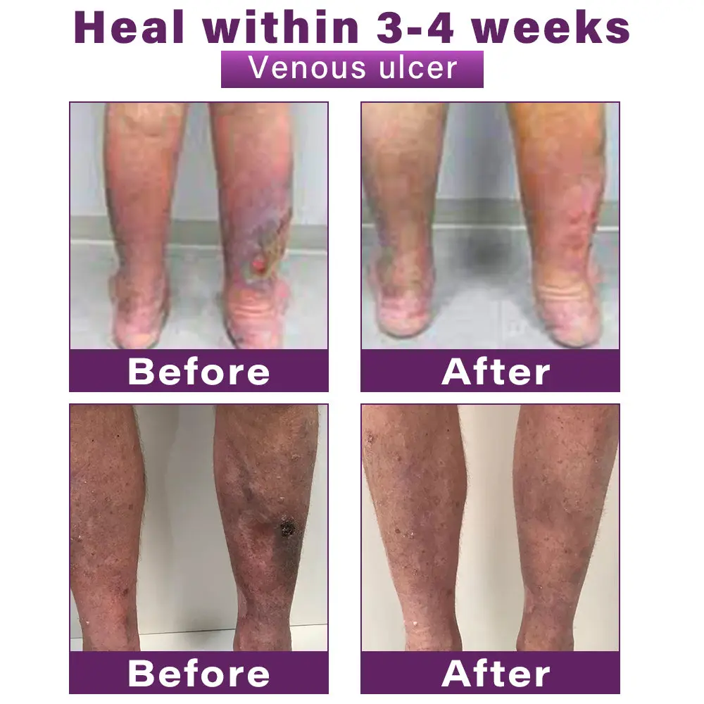 Polidocanol Nano Varicose Vein Patch - Image 4