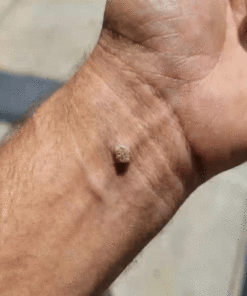 Soluble Microneedle Botanical Skin Tag Removal Patch