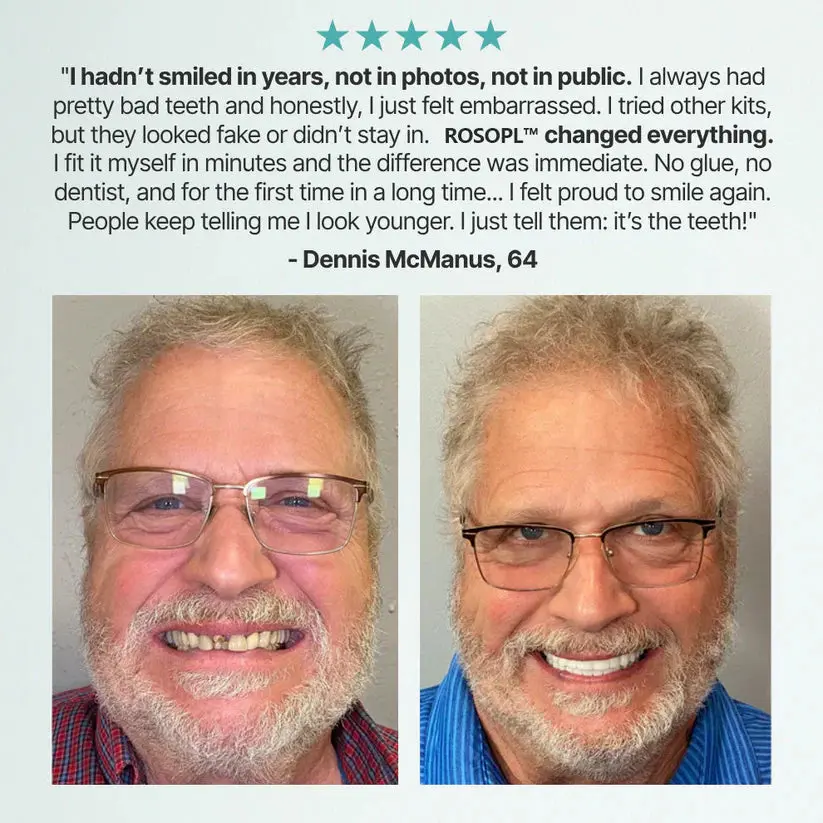 Medical Full Denture with Strong Suctiond Custom-Fit Full Functional Dentures - Image 9